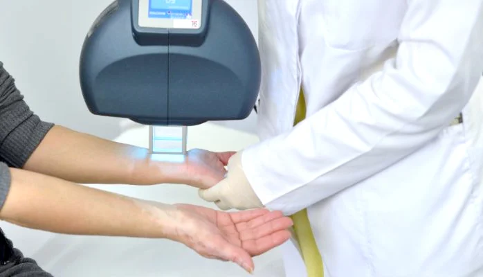 Excimer phototherapy Huda Mekky Excimer phototherapy Huda Mekky