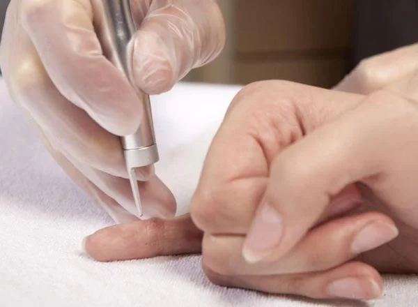Laser Surgery Dr Huda Mekky DermaView Laser Surgery Dr Huda Mekky DermaView